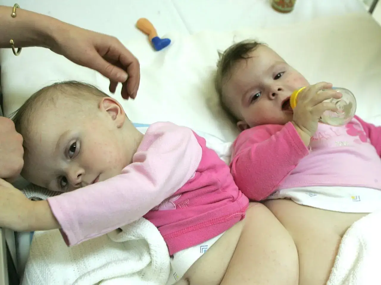 Dwie dziewczynki, bliźniaczki syjamskie z Janikowa, leżą obok siebie. Jedna pije z butelki, druga opiera głowę na ręce.